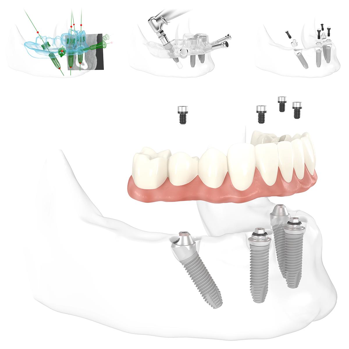 Schematische Abbildung der positionen der Implantate bei All-on-4 in der Zahnarztpraxis Pfau in Rottweil