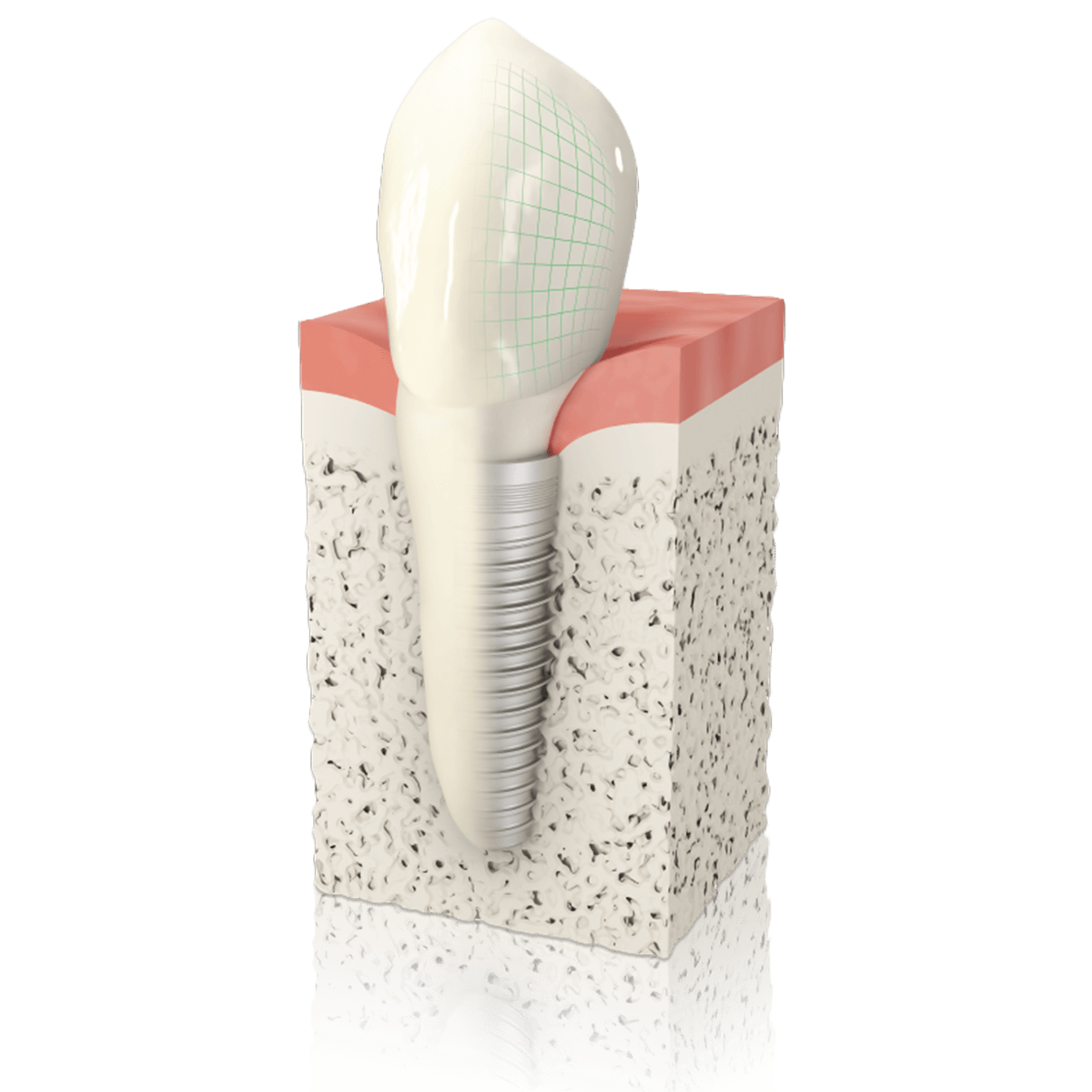 3D-Computer Bild eines Implantats im Knochen